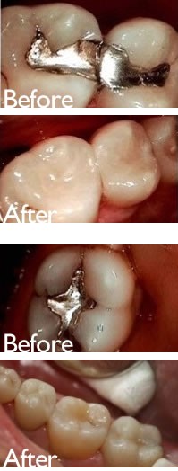 Tooth Colored Bonded Fillings in San Marino