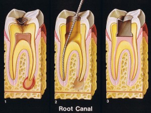Root Canals in San Marino