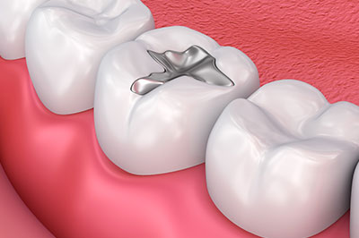 Amalgam Fillings San Marino