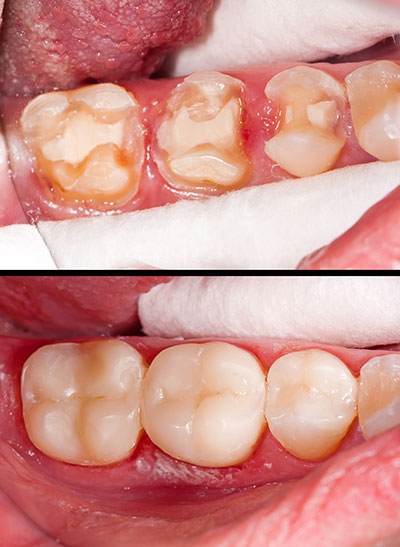 Tooth Fillings: Tooth-colored Composites