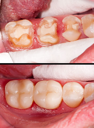 San Marino Composite Fillings