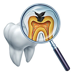 San Marino Tooth Decay