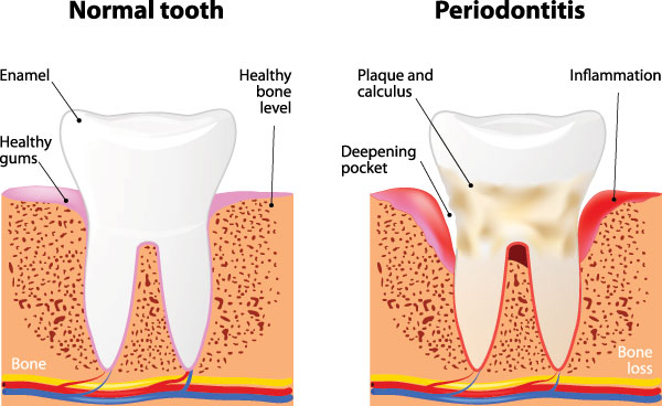 Periodontal (Gum) Disease