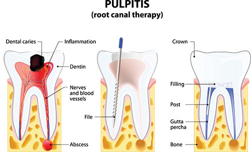 Root Canals in San Marino