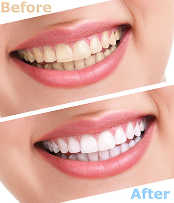 teeth whitening in San Marino