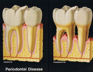 Periodontal Therapy in San Marino