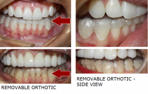 Full Mouth Rehabilitation Treatment in San Marino