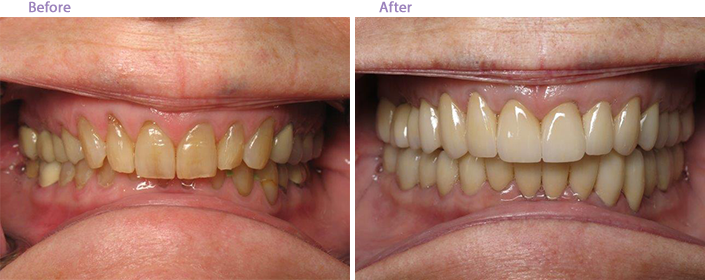 Before and After Dental Implants in San Marino