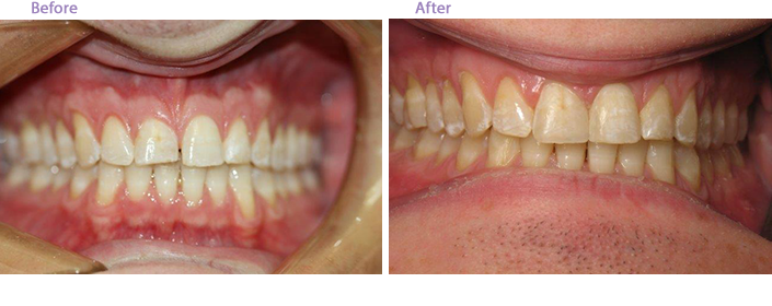 San Marino Before and After Dental Fillings