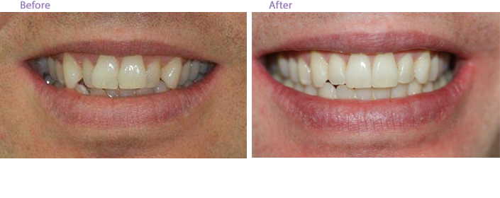 Before and After Dental Braces in San Marino