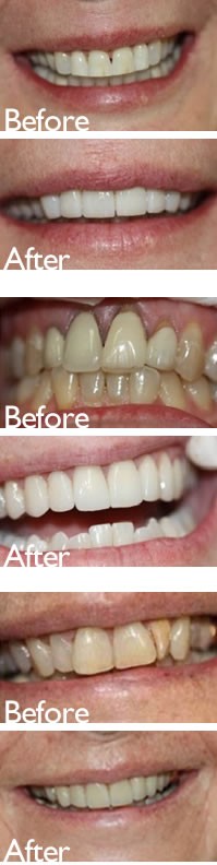 Smile Makeover in San marino